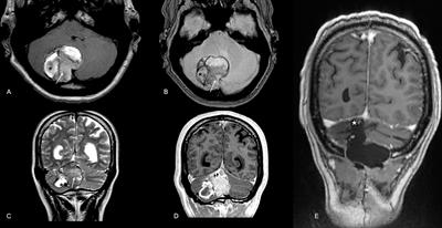 Case Report: Differential Genomics and Evolution of a Meningeal Melanoma Treated With Ipilimumab and Nivolumab